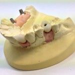 Implant crowns and abutments