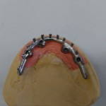 Milled Titianium bridge