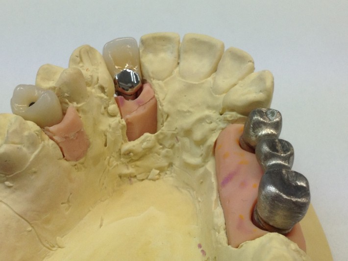 Implant - crowns and bridges